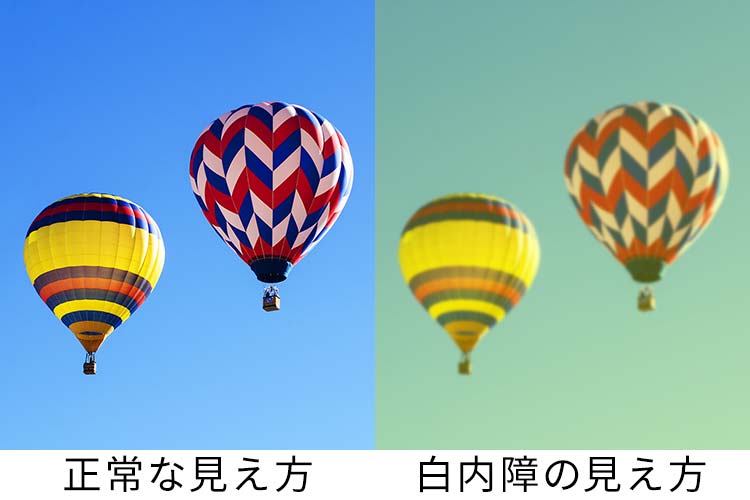 白内障イメージ