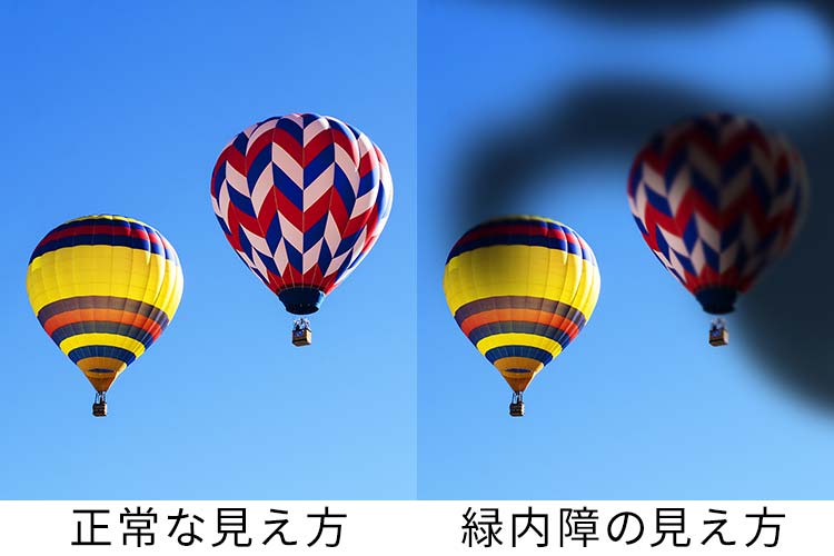 緑内障イメージ