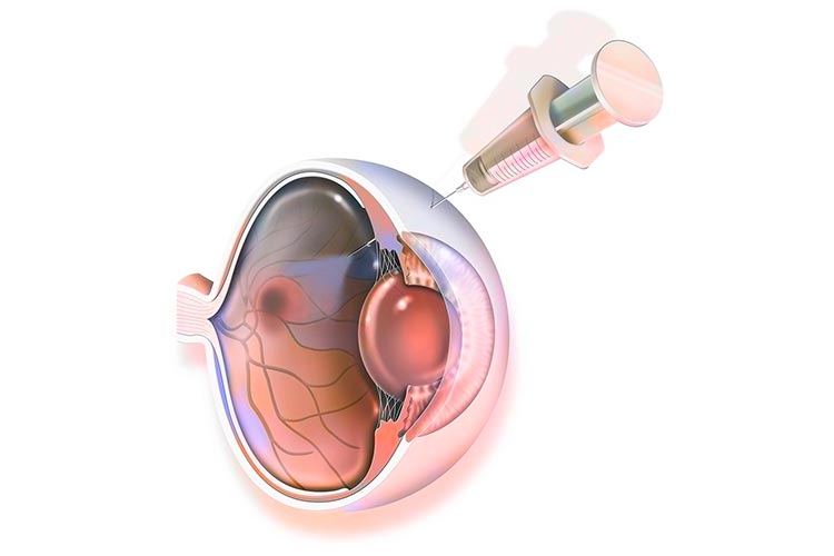 硝子体注射イメージ